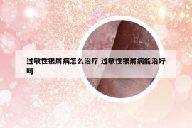 過敏性銀屑病怎么治療 過敏性銀屑病能治好嗎