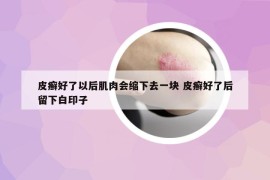 皮癬好了以后肌肉會縮下去一塊 皮癬好了后留下白印子