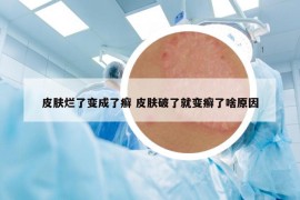 皮膚爛了變成了癬 皮膚破了就變癬了啥原因