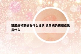 銀屑癬初期都有什么癥狀 銀屑病的初期癥狀是什么