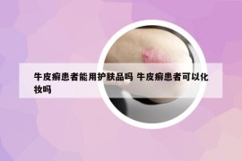 牛皮癬患者能用護(hù)膚品嗎 牛皮癬患者可以化妝嗎