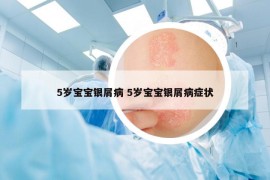 5歲寶寶銀屑病 5歲寶寶銀屑病癥狀