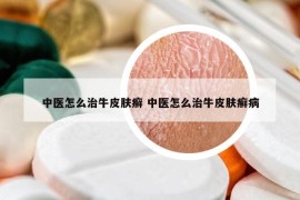 中醫(yī)怎么治牛皮膚癬 中醫(yī)怎么治牛皮膚癬病