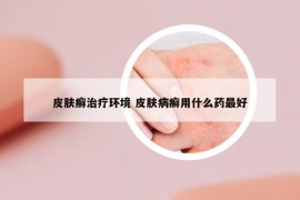 皮膚癬治療環(huán)境 皮膚病癬用什么藥最好