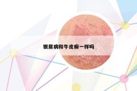 銀屑病和牛皮癬一樣嗎