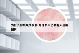 為什么會(huì)出現(xiàn)頭皮蘚 為什么頭上會(huì)有頭皮癬圖片