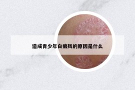 造成青少年白癜風的原因是什么