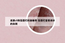 皮膚ct和伍德燈的準(zhǔn)確率 伍德燈容易誤診的白斑