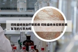 切除扁桃體治療銀屑病 切除扁桃體后銀屑病復(fù)發(fā)的幾率大嗎