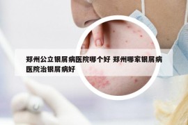 鄭州公立銀屑病醫(yī)院哪個好 鄭州哪家銀屑病醫(yī)院治銀屑病好