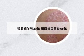 銀屑病關(guān)節(jié)30年 銀屑病關(guān)節(jié)炎40年