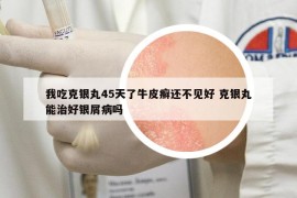 我吃克銀丸45天了牛皮癬還不見好 克銀丸能治好銀屑病嗎