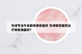 天津?qū)Ｖ闻Ｆぐ_有哪些醫(yī)院 天津哪家醫(yī)院治療銀屑病最好?