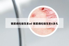 銀屑病吃維生素ad 銀屑病吃維生素A多久