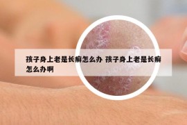 孩子身上老是長癬怎么辦 孩子身上老是長癬怎么辦啊