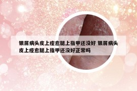 銀屑病頭皮上痊愈腿上指甲還沒好 銀屑病頭皮上痊愈腿上指甲還沒好正常嗎