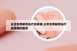北京生物制劑治療皮膚病 北京生物制劑治療皮膚病的醫(yī)院