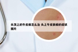 頭頂上的牛皮癬怎么治 頭上牛皮膚癬的癥狀圖片