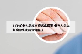 50歲的老人頭皮有癬怎么回事 老年人頭上長癬掉頭皮屑如何解決