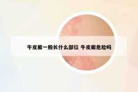 牛皮廨一般長(zhǎng)什么部位 牛皮廨危險(xiǎn)嗎