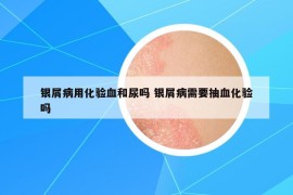 銀屑病用化驗(yàn)血和尿嗎 銀屑病需要抽血化驗(yàn)嗎