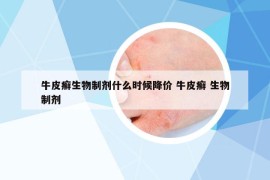 牛皮癬生物制劑什么時候降價 牛皮癬 生物制劑
