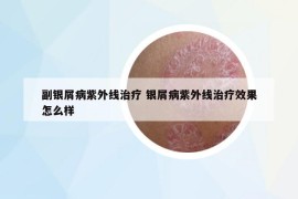 副銀屑病紫外線治療 銀屑病紫外線治療效果怎么樣