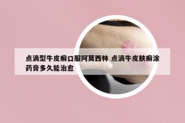 點(diǎn)滴型牛皮癬口服阿莫西林 點(diǎn)滴牛皮膚癬涂藥膏多久能治愈