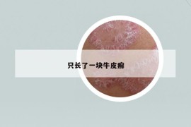 只長了一塊牛皮癬