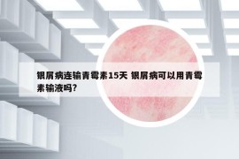 銀屑病連輸青霉素15天 銀屑病可以用青霉素輸液嗎?