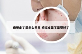 癬脫皮了是怎么回事 癬掉皮是不是要好了