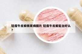 輕度牛皮癬銀屑病圖片 輕度牛皮廨能治好么?