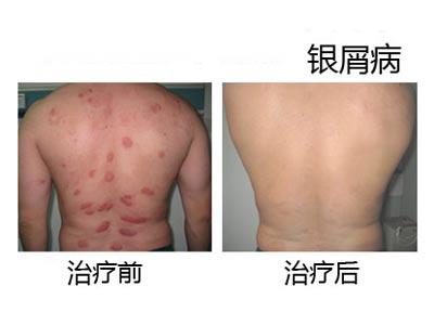 銀屑病的發(fā)病原因