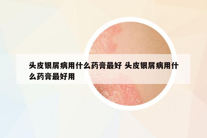 頭皮銀屑病用什么藥膏最好 頭皮銀屑病用什么藥膏最好用