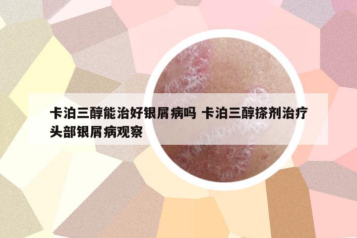 卡泊三醇能治好銀屑病嗎 卡泊三醇搽劑治療頭部銀屑病觀察