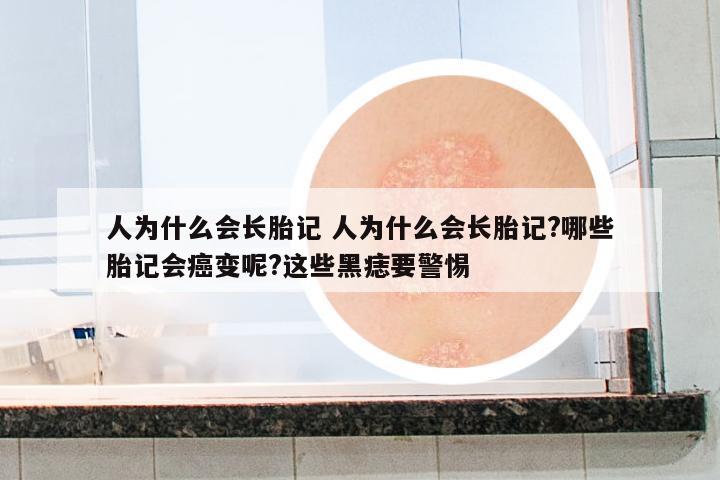人為什么會長胎記 人為什么會長胎記?哪些胎記會癌變呢?這些黑痣要警惕