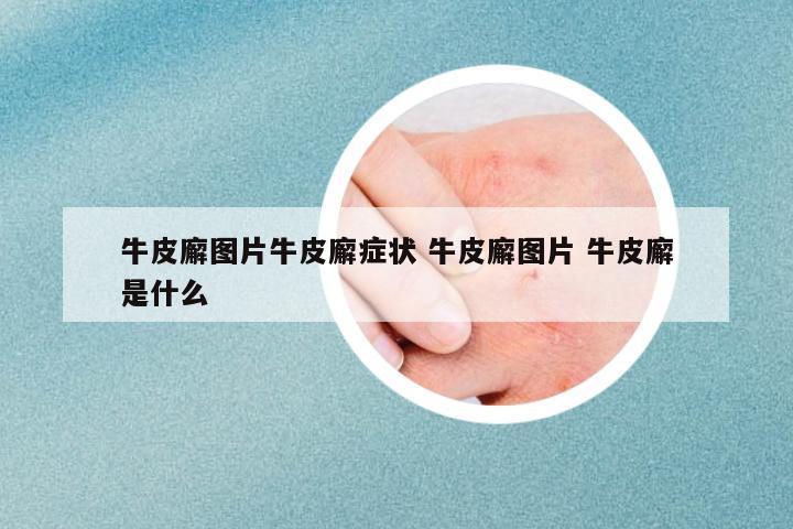 牛皮廨圖片牛皮廨癥狀 牛皮廨圖片 牛皮廨是什么