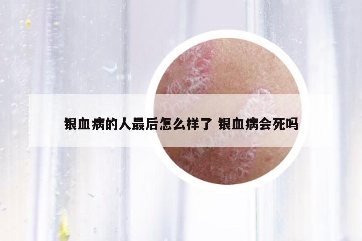 銀血病的人最后怎么樣了 銀血病會(huì)死嗎