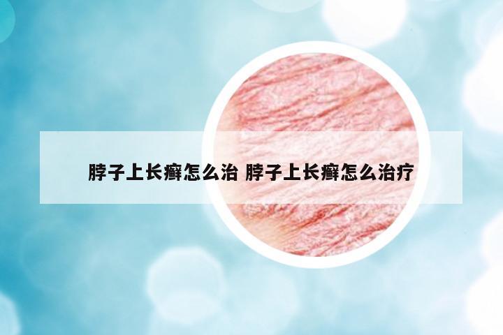 脖子上長(zhǎng)癬怎么治 脖子上長(zhǎng)癬怎么治療