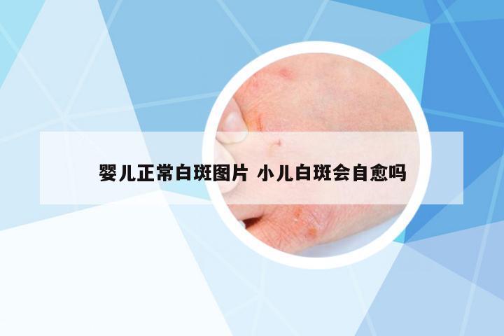 嬰兒正常白斑圖片 小兒白斑會(huì)自愈嗎