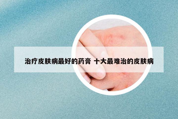 治療皮膚病最好的藥膏 十大最難治的皮膚病