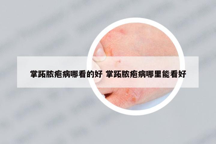 掌跖膿皰病哪看的好 掌跖膿皰病哪里能看好