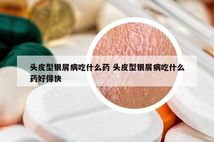 頭皮型銀屑病吃什么藥 頭皮型銀屑病吃什么藥好得快
