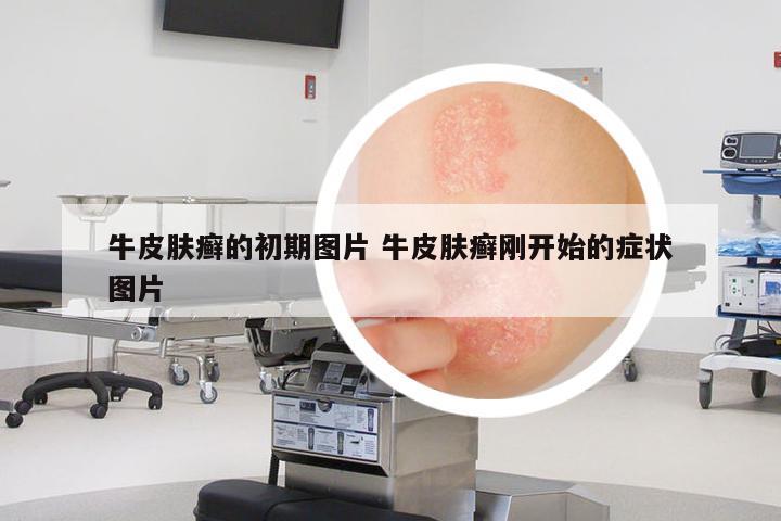 牛皮膚癬的初期圖片 牛皮膚癬剛開始的癥狀圖片