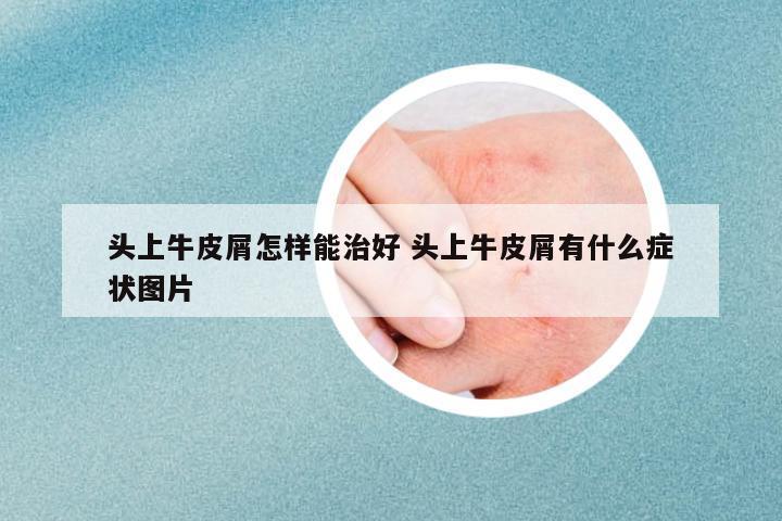 頭上牛皮屑怎樣能治好 頭上牛皮屑有什么癥狀圖片