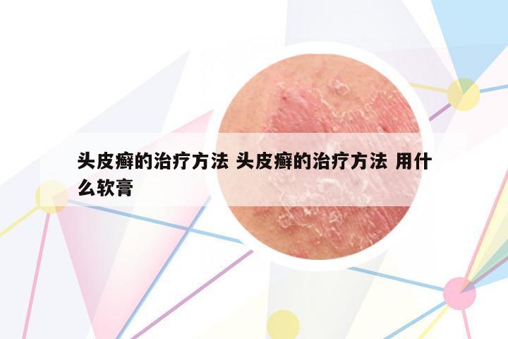 頭皮癬的治療方法 頭皮癬的治療方法 用什么軟膏