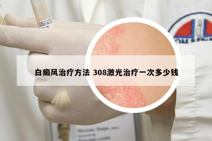 白癜風(fēng)治療方法 308激光治療一次多少錢