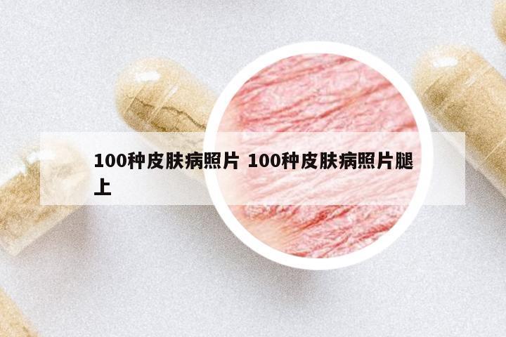 100種皮膚病照片 100種皮膚病照片腿上