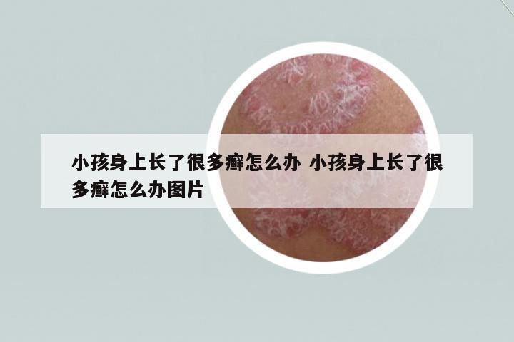 小孩身上長了很多癬怎么辦 小孩身上長了很多癬怎么辦圖片