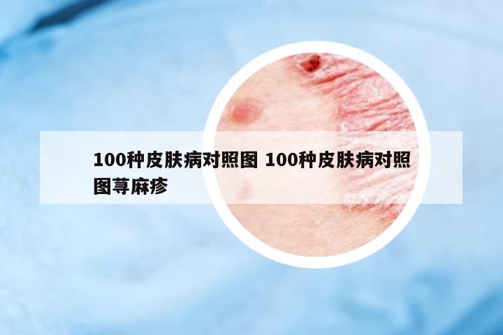 100種皮膚病對(duì)照?qǐng)D 100種皮膚病對(duì)照?qǐng)D蕁麻疹